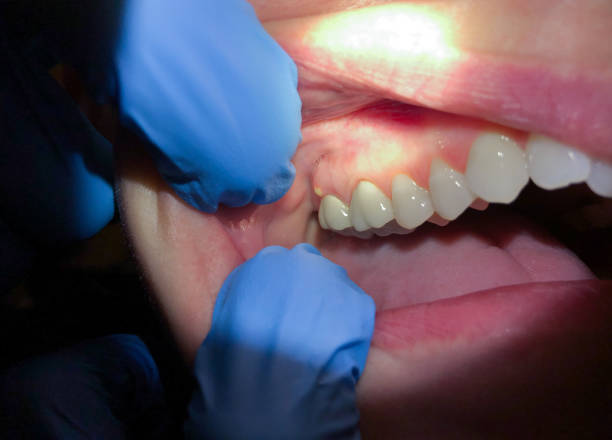 Best Emergency Tooth Extraction in Kingman, KS